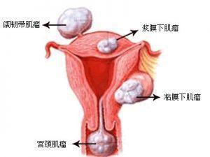 子宫腺肌症手术不仅仅是切除子宫的抉择