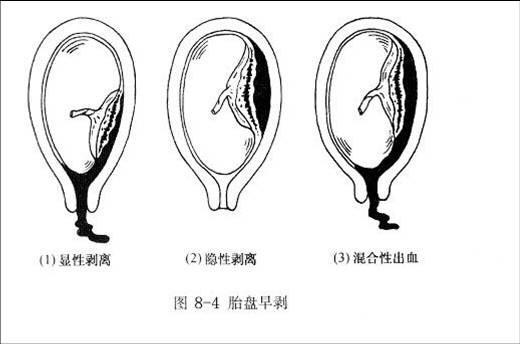 胎盘早剥的四个征象有哪些