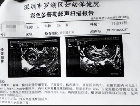 揭秘十月怀胎第一步，怀孕一个月的B超之旅