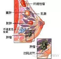 春天，乳腺养护的黄金季节